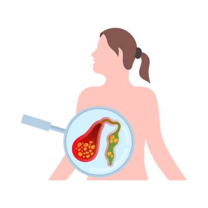 Cholecystitis