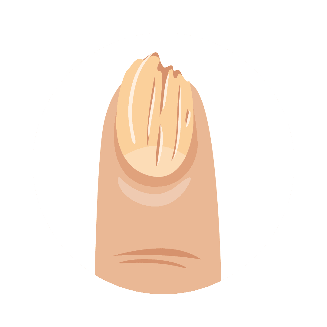 Nail brittleness