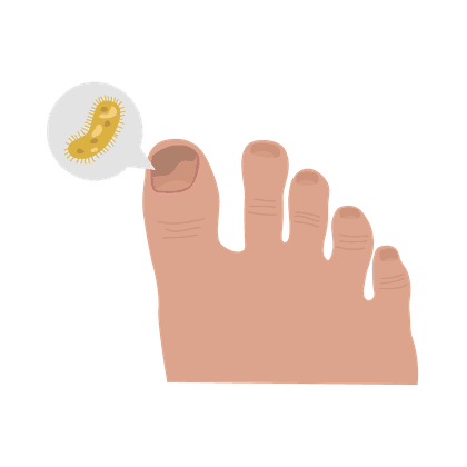 Fungal lesions of the nails and skin